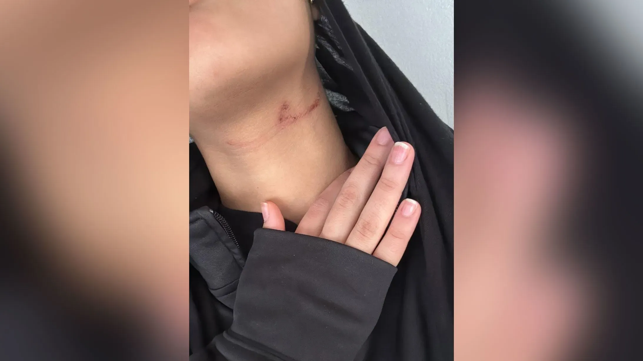 علامة حمراء على رقبة فتاة ترتدي سترة، تشير إلى إصابة تعرضت لها خلال اعتداء في المدرسة بسبب كراهيتها لدينها وعرقها.