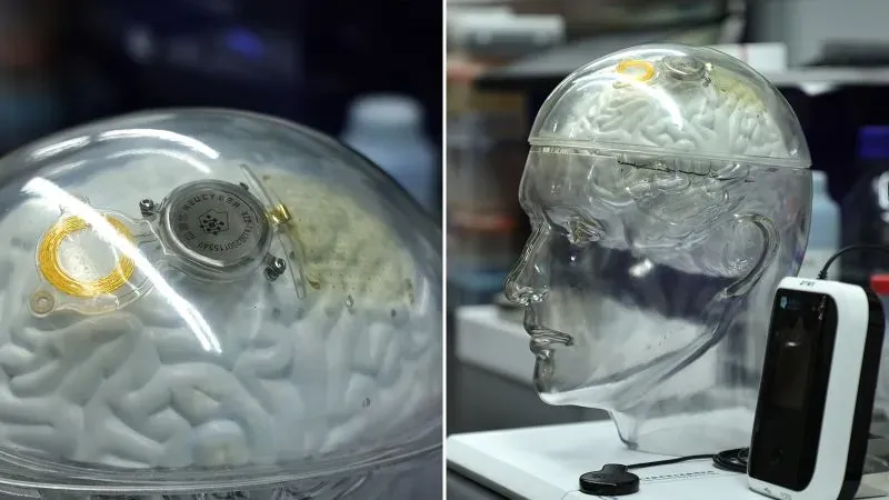 نموذج لواجهة حاسوبية لاسلكية للدماغ، يظهر شريحة بيناو-1 داخل رأس شفاف، يمثل تقدم التكنولوجيا في علاج مرضى التصلب الجانبي الضموري.