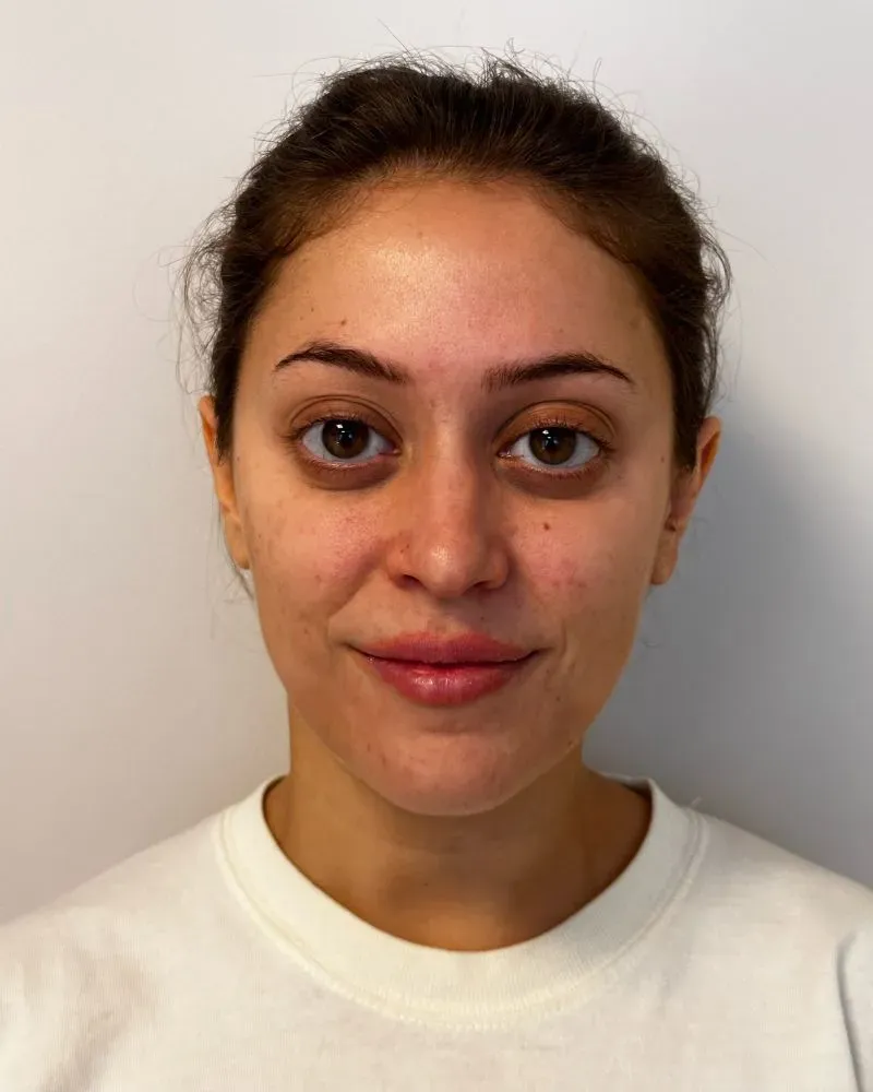 امرأة شابة ذات بشرة طبيعية، تظهر بوضوح آثار جراحة تجميلية حديثة حول وجهها، مع كدمات خفيفة وشقوق جراحية بجانب أذنها.