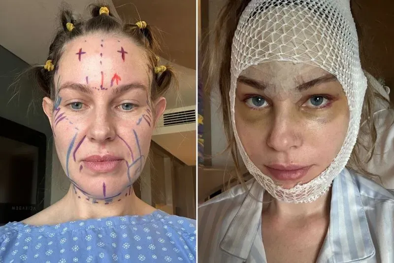 تظهر كيم هابرلي قبل وبعد عملية شد الوجه، مع علامات جراحية واضحة وكدمات حول عينيها، مما يبرز آثار الجراحة التجميلية الحديثة.