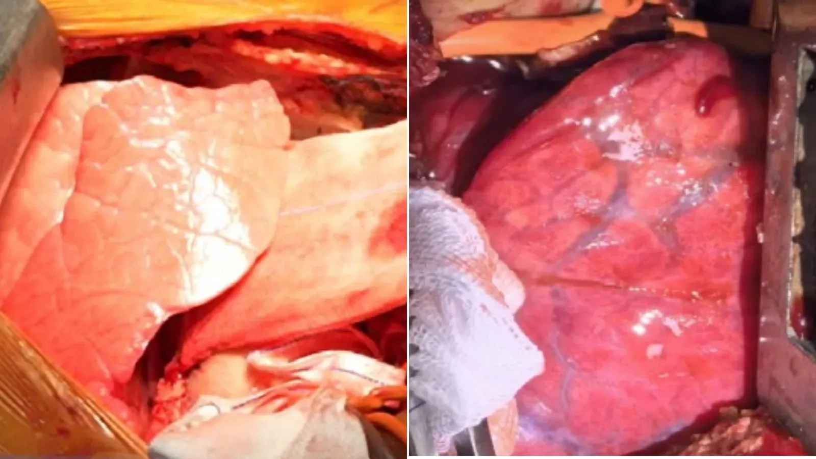 زرع رئة خنزير معدلة وراثيًا في رجل ميت دماغيًا، حيث أظهرت التجربة علامات رفض بعد تسعة أيام، مما يبرز تحديات زراعة الأعضاء.