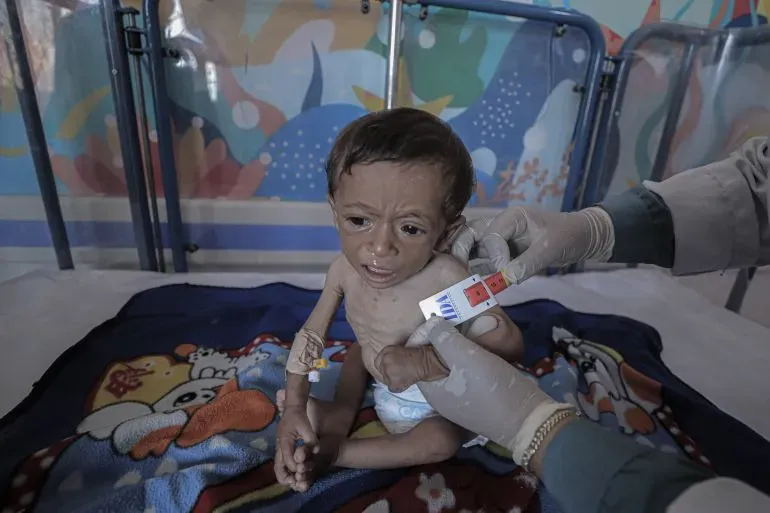 طفل يعاني من سوء التغذية الحاد في مستشفى بغزة، حيث يتم قياس محيط ذراعه باستخدام شريط قياس لتحديد حالته الصحية.