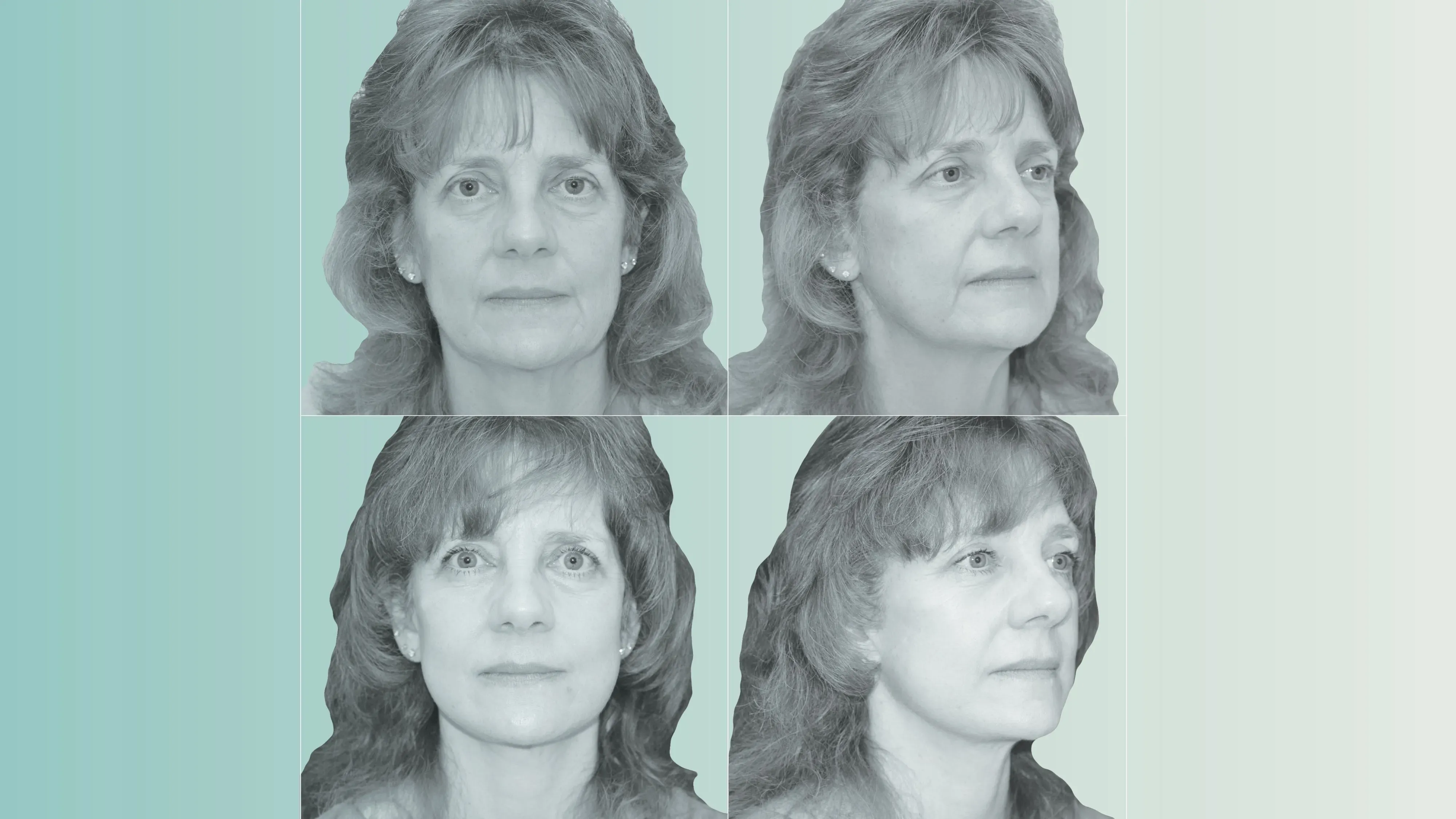 صور توضح تأثير فقدان الوزن على مظهر الوجه، مع التركيز على ترهل الجلد وتغيرات الوجه بعد استخدام أدوية إنقاص الوزن.