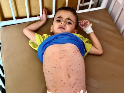طفل مريض مستلقي على سرير في المستشفى، يظهر على جسده الطفح الجلدي والجروح، يعكس تأثير سوء التغذية والعدوى في غزة.