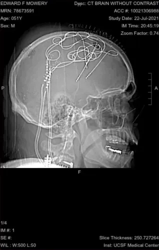 صورة لنتيجة تصوير مقطعي محوري للدماغ تُظهر الأسلاك والأجهزة المستخدمة في علاج الألم المزمن، مما يعكس التقدم في إدارة الألم.