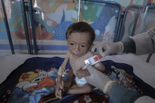 طفل يعاني من سوء التغذية الحاد في مستشفى بغزة، حيث يتم قياس محيط ذراعه باستخدام شريط قياس لتحديد حالته الصحية.