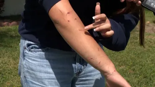 ذراع فتاة تظهر عليها آثار عضات وكدمات من هجوم أسد البحر، تعبيرًا عن زيادة السلوك العدواني لدى الحيوانات بسبب التسمم.