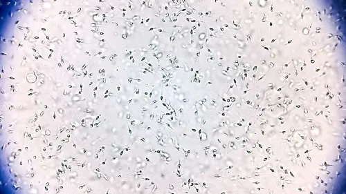 عينة من الحيوانات المنوية تحت المجهر، تُظهر الكمية الكبيرة من الحيوانات المنوية المستخدمة في إنجاب أطفال يحملون طفرة جينية نادرة.