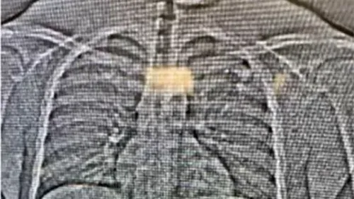 صورة بالأشعة السينية تظهر ما يُعتقد أنه أقراط ماسية مسروقة من تيفاني آند كو داخل جسم المشتبه به بعد القبض عليه في فلوريدا.