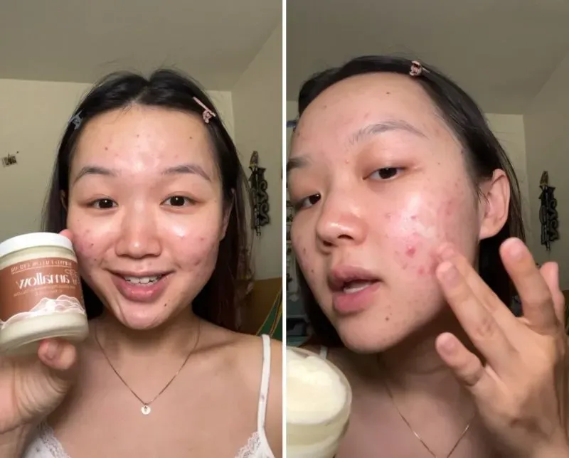 امرأة مبتسمة تحمل وعاءً من منتج تجميلي، تُظهر بشرتها التي تعاني من حب الشباب وتطبق المنتج على وجهها.