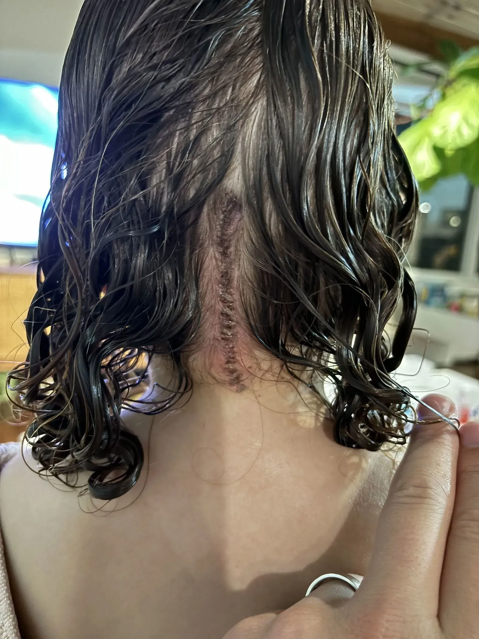 ندبة جراحية على رأس جولييت، البالغة من العمر 5 سنوات، بعد خضوعها لعمليتين لعلاج سرطان الدماغ.