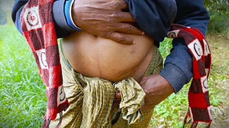 تظهر الصورة رجلًا يحمل بيده بطنه، مع وجود ندبة جراحية واضحة، مما يعكس معاناته بعد بيع كليته في سياق تجارة الأعضاء غير المشروعة.