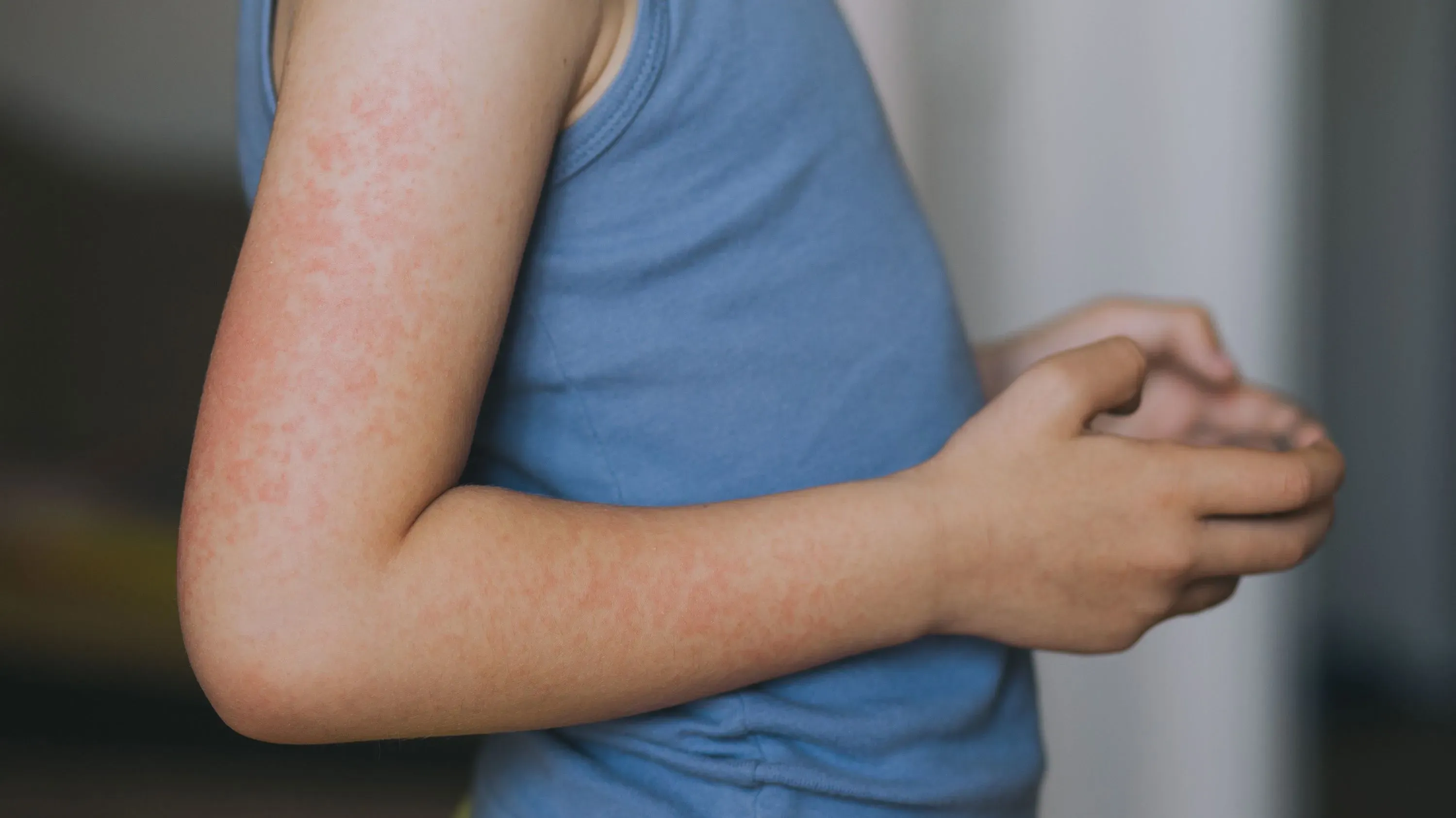 طفل يرتدي قميصًا أزرق ويظهر على ذراعه طفح جلدي أحمر، مما يشير إلى إصابته بالحصبة في سياق ارتفاع الحالات في الولايات المتحدة.