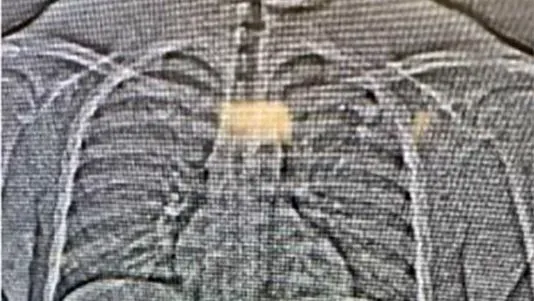 صورة بالأشعة السينية تظهر ما يُعتقد أنه أقراط ماسية مسروقة من تيفاني آند كو داخل جسم المشتبه به بعد القبض عليه في فلوريدا.